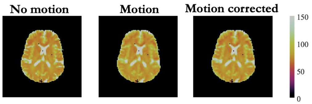 La correction du mouvement pour des cartes T2 en 3D de qualité
