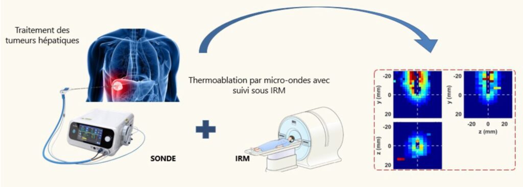 Suivi par thermométrie IRM du processus de thermoablation d’une tumeur dans le foie. Les nouveaux modèles développés par l'équipe de chercheurs permettent de reconstruire en temps réel le champ des températures dans les zones où elles ne sont pas mesurées. © JLB/I2M